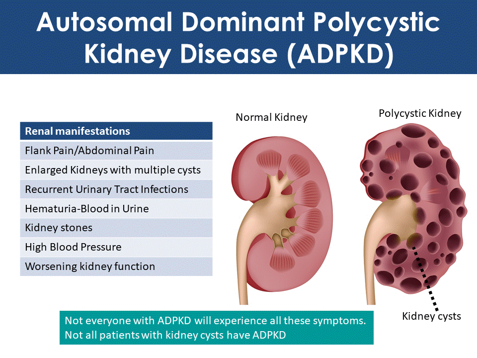 cytsic kidney disease