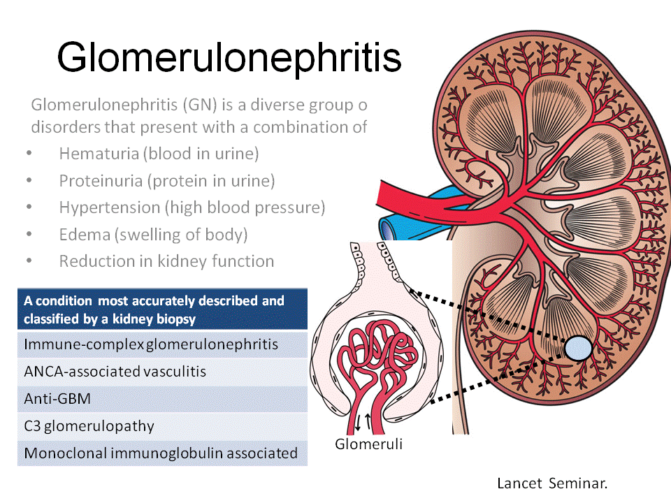 Acute Kidney Injury - Glomerulonephritis 